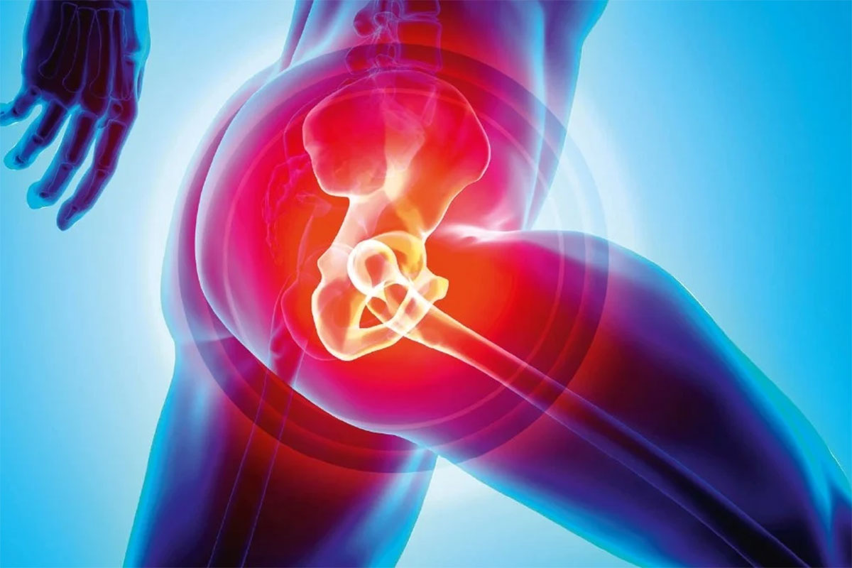 Joint Replacement