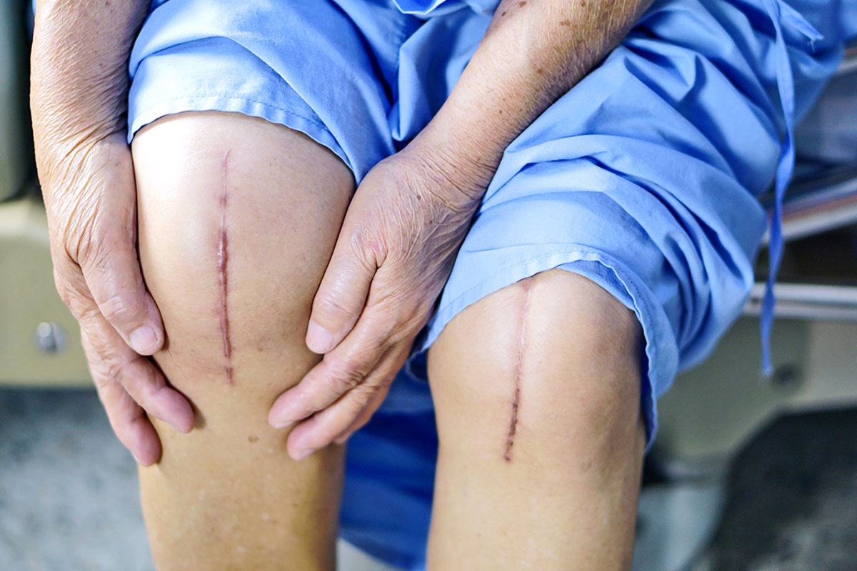 Joint Replacement