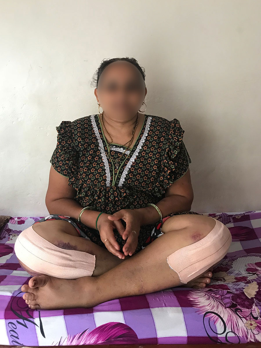 Knee Replacement Surgery