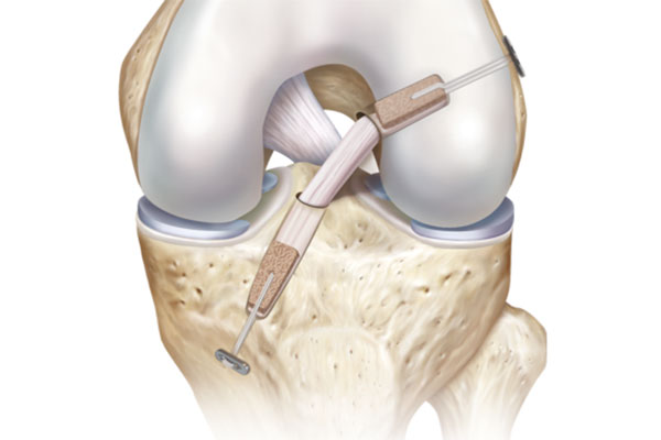 Sports Medicine & Arthroscopy - ACL Injury