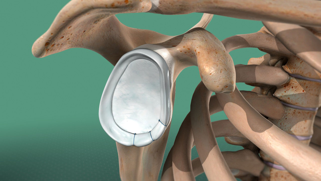 Sports Medicine & Arthroscopy - Bankart Lesion After Surgery