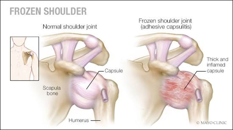 Sports Medicine & Arthroscopy - Frozen Shoulder