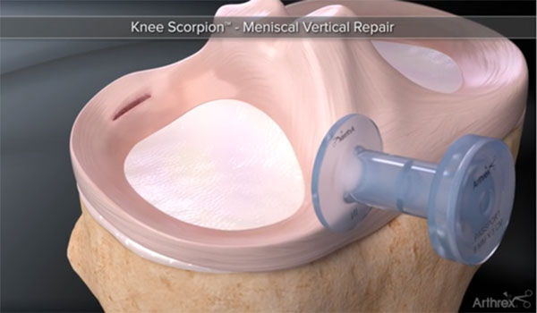 Sports Medicine & Arthroscopy - Meniscus Injury