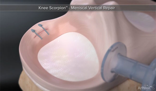 Sports Medicine & Arthroscopy - Meniscus Injury