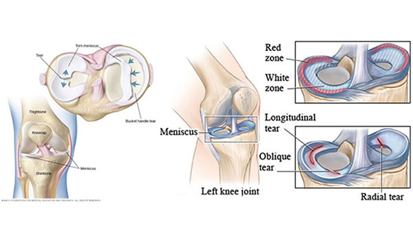 Sports Medicine & Arthroscopy - Meniscus Injury