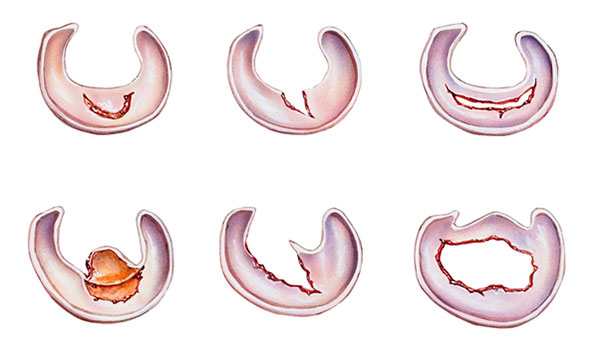 Sports Medicine & Arthroscopy - Meniscus Injury
