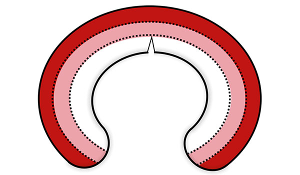Sports Medicine & Arthroscopy - Meniscus Injury