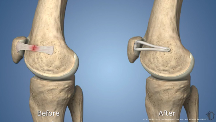 Sports Medicine & Arthroscopy - MPFL Reconstruction