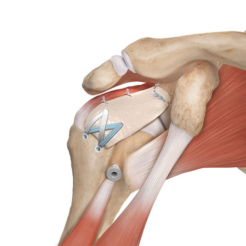 Sports Medicine & Arthroscopy - Rotator Cuff After Surgery
