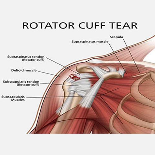 Sports Medicine & Arthroscopy - Rotator Cuff Tear