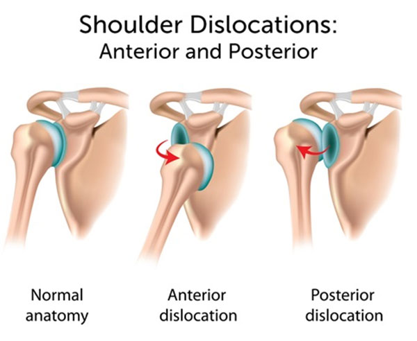 Sports Medicine & Arthroscopy - Shoulder Dislocation And Instability