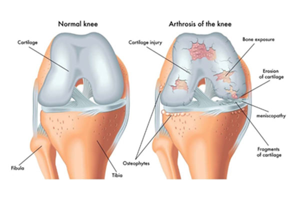 Total Knee Replacement Surgery