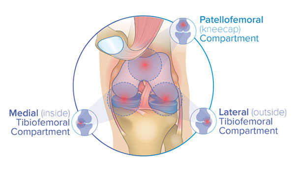 Partial Knee Replacement