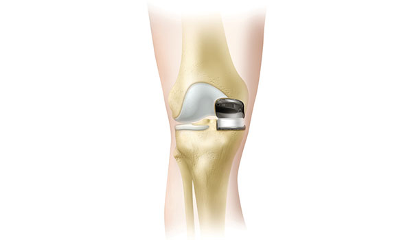 Partial Knee Replacement